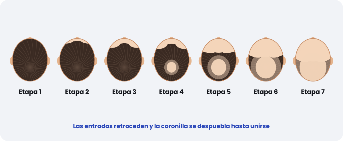 Etapas de la calvicie